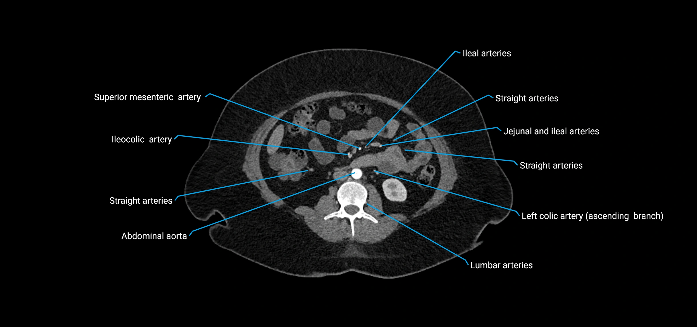 CTA abdomen axial cross sectional anatomy labelled image_98 (2).webp